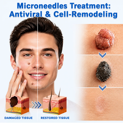 🇺🇸🇺🇸𝐇𝐢𝐬𝐤𝐢𝐧® 2-in-1 Microneedle & Hydrocolloid Patch | Removes raised moles, acne, flat warts, and skin tags | Helps improve wrinkles, scars, and blemishes | Invisible patches for face and body
