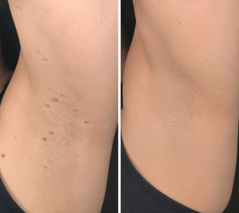 🇺🇸🇺🇸𝐇𝐢𝐬𝐤𝐢𝐧® 2-in-1 Microneedle & Hydrocolloid Patch | Removes raised moles, acne, flat warts, and skin tags | Helps improve wrinkles, scars, and blemishes | Invisible patches for face and body