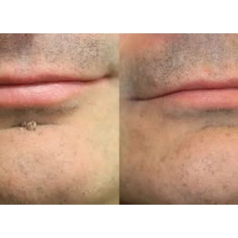 🇺🇸🇺🇸𝐇𝐢𝐬𝐤𝐢𝐧® 2-in-1 Microneedle & Hydrocolloid Patch | Removes raised moles, acne, flat warts, and skin tags | Helps improve wrinkles, scars, and blemishes | Invisible patches for face and body