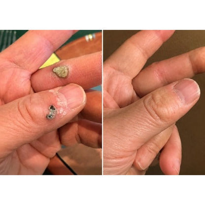 🇺🇸🇺🇸𝐇𝐢𝐬𝐤𝐢𝐧® 2-in-1 Microneedle & Hydrocolloid Patch | Removes raised moles, acne, flat warts, and skin tags | Helps improve wrinkles, scars, and blemishes | Invisible patches for face and body