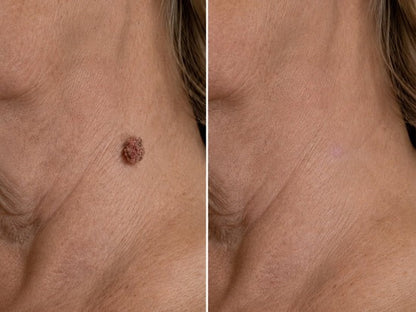 🇺🇸🇺🇸𝐇𝐢𝐬𝐤𝐢𝐧® 2-in-1 Microneedle & Hydrocolloid Patch | Removes raised moles, acne, flat warts, and skin tags | Helps improve wrinkles, scars, and blemishes | Invisible patches for face and body