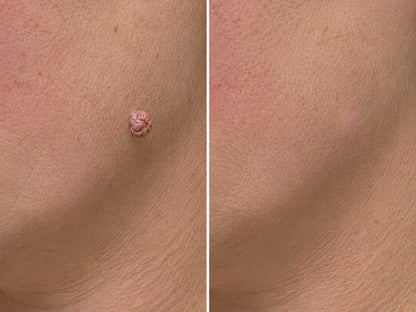 🇺🇸🇺🇸𝐇𝐢𝐬𝐤𝐢𝐧® 2-in-1 Microneedle & Hydrocolloid Patch | Removes raised moles, acne, flat warts, and skin tags | Helps improve wrinkles, scars, and blemishes | Invisible patches for face and body
